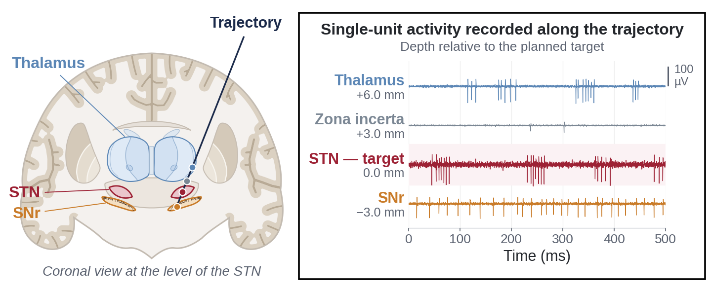 Schematic of microelectrode recording during DBS surgery: a coronal brain section with the electrode trajectory to the subthalamic nucleus, and single-unit traces recorded at successive depths along it