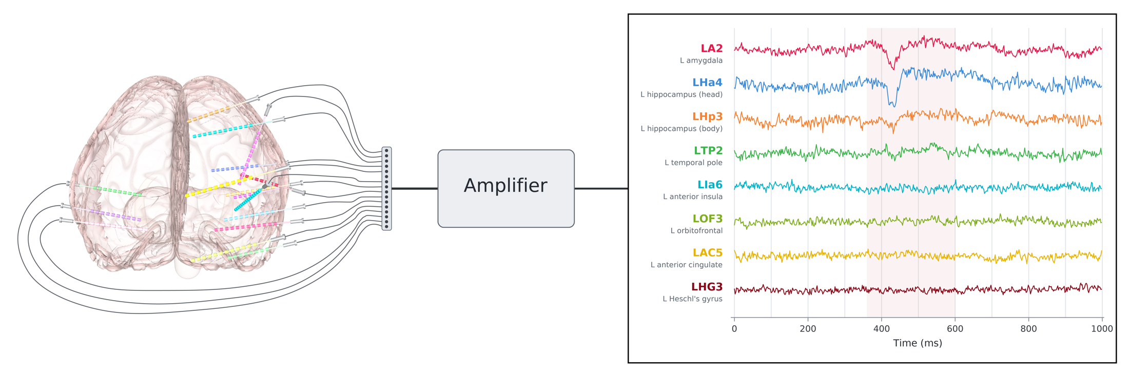 Diagram of stereo-EEG electrodes recording from multiple brain regions, amplified, and displayed as multi-channel time series